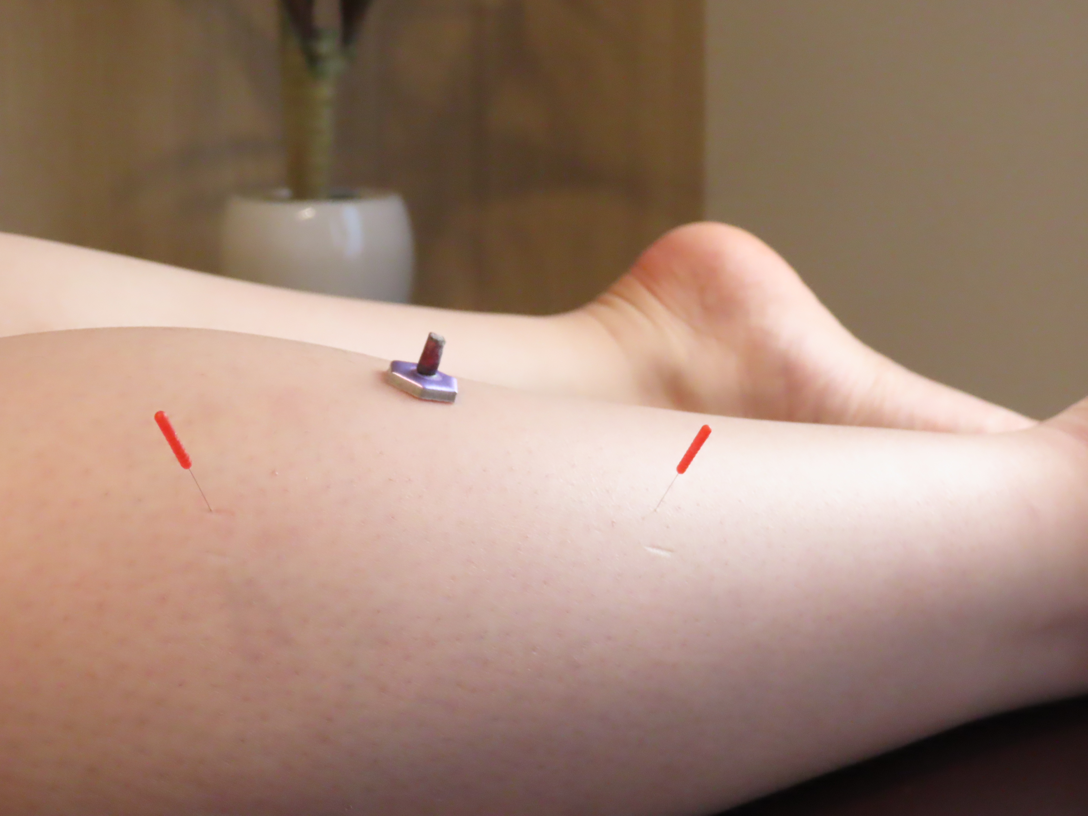 鍼治療の効果